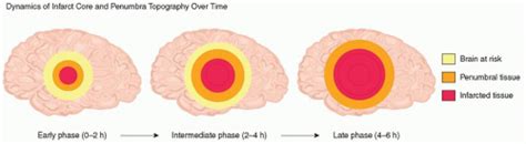 Acute Ischemic Stroke | Neupsy Key