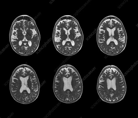 Early-onset Alzheimer's disease, MRI scan - Stock Image - C018/0505 ...