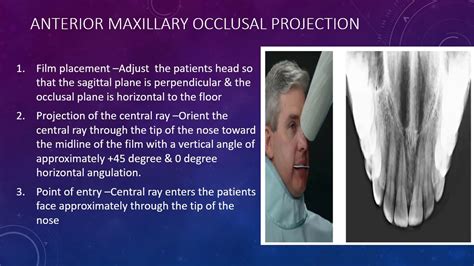 Occlusal radiographs - YouTube