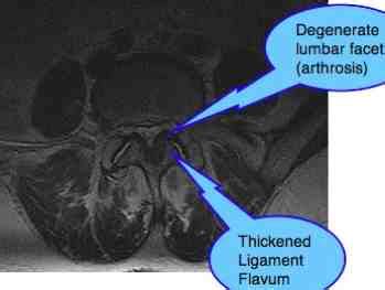 Lumbar Facet Arthropathy Spondylolysthesis causes lower back and leg pain.