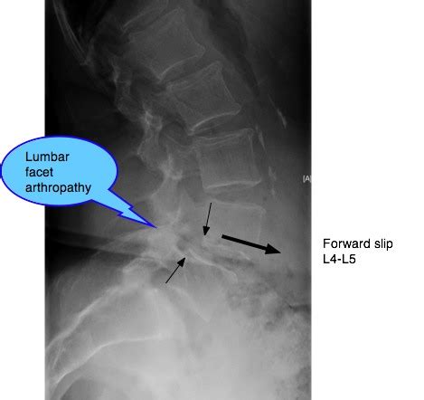 Lumbar Facet Arthropathy Spondylolysthesis with lower back & leg pain.