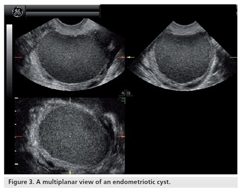 Ultrasound and its role in assisted reproduction treatment