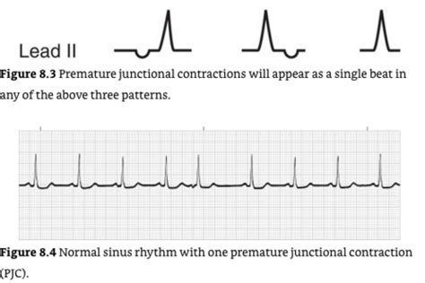 Junctional Arrhythmias and AV Blocks Flashcards | Quizlet