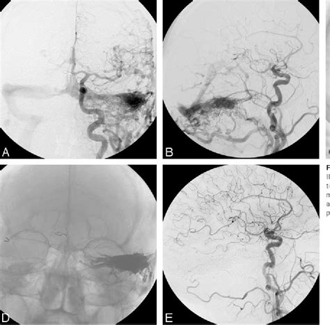 Dural Arteriovenous Fistula | Semantic Scholar