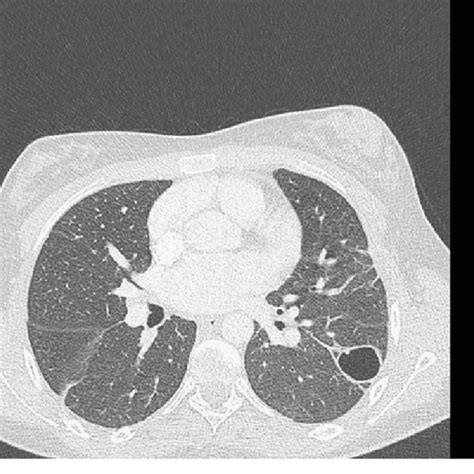 (PDF) Lemierre's syndrome