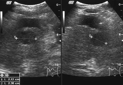 Hypodense lesion (27 × 23 mm) in ultrasound. | Download Scientific Diagram