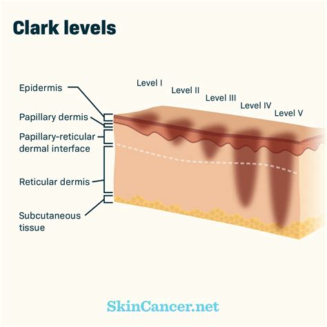 Melanoma Skin Cancer Diagram
