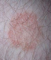 Itchy Groin Causes With or Without Itching Skin Rash | Healthhype.com