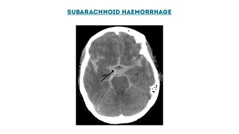 Stroke Classification | Bamford | Oxford | Geeky Medics