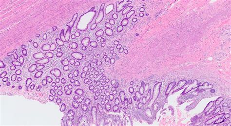 Meckel Diverticulum Histology