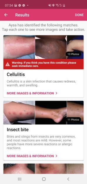 Aysa Points Out Cellulitis Infection, Saves Man's Life » Ask Aysa