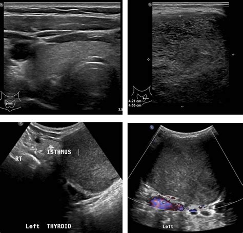 Thyroglossal duct cyst – Radiology Cases