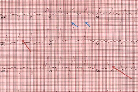 STEMI Mimics: Part 2, Left Bundle Branch Block