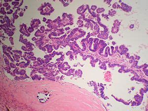 Intracystic papillary carcinoma of the breast - Libre Pathology