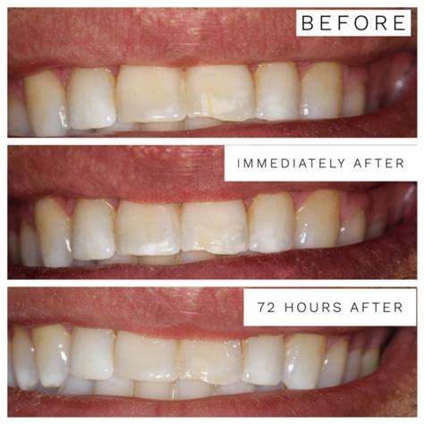 livraison à domicile Chasser lInternet how to get rid of white spots on teeth shabiller ...
