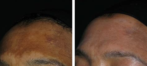 Pigmentation | Before & After | Kingsway Dermatology