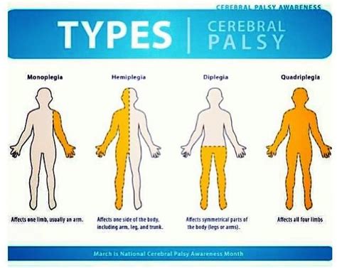 Learn all about the different types of #cerebralpalsy. | Types of cerebral palsy, Cerebral palsy ...