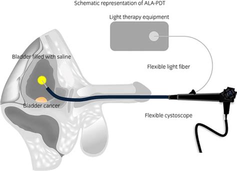 5‐Aminolevulinic acid‐mediated photodynamic therapy for bladder cancer - Inoue - 2017 ...