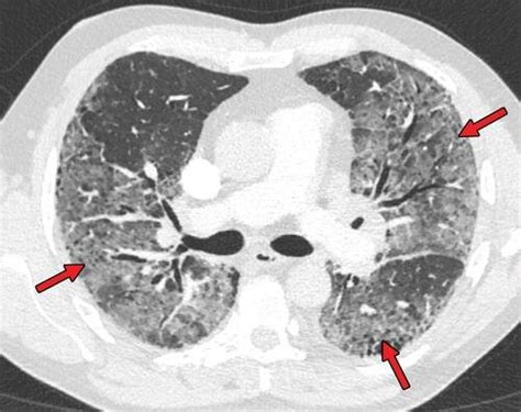 CORADS (5) CT chest findings. | Download Scientific Diagram