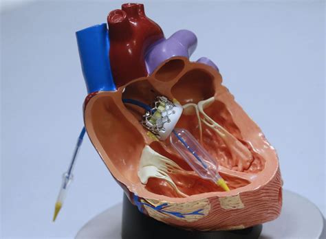 Aortic valve replacement widens heart patients' options | Health ...