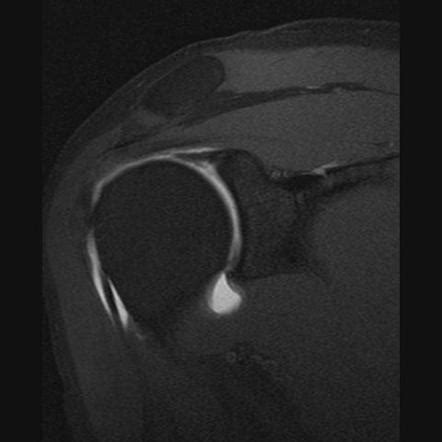 Anterior Superior Labral Tear Shoulder