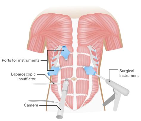 Laparotomy and Laparoscopy | Concise Medical Knowledge