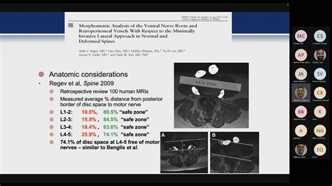 LLIF Technique presented by Gregory M. Mundis, Jr., MD : San Diego Spine Foundation Fellows ...