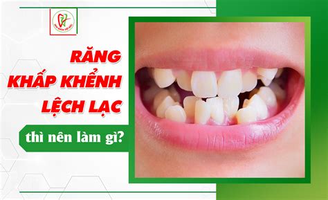 RĂNG KHẤP KHỂNH, LỆCH LẠC THÌ NÊN LÀM GÌ? - Nha Khoa Việt Đức