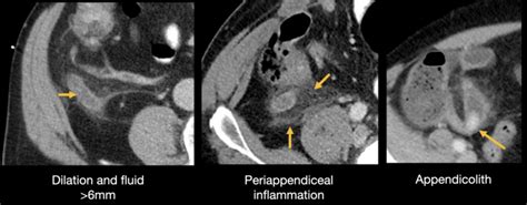 Abdominal CT: appendicitis • LITFL • Radiology Library