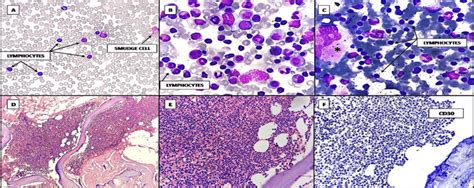 [A] Peripheral Smear (20x) showing absolute lymphocytosis with small... | Download Scientific ...