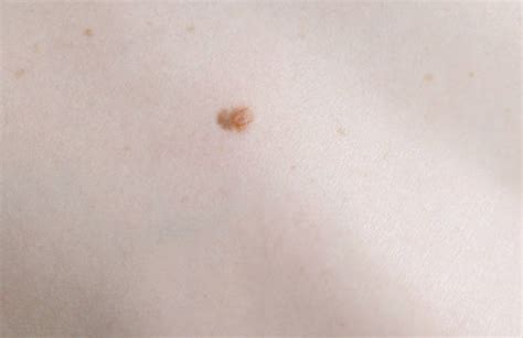 Best Mole Melanoma Skin Condition Warty Stock Photos, Pictures & Royalty-Free Images - iStock