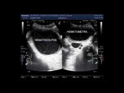 Ultrasound Video showing Hematocolpos with hematometra or Hemometra ...