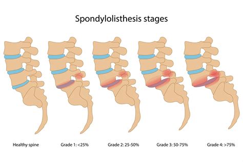 กระดูกสันหลังยุบ หัก ย่น โก่ง ต้องทำอย่างไร ? - Bangkok Advanced Clinics