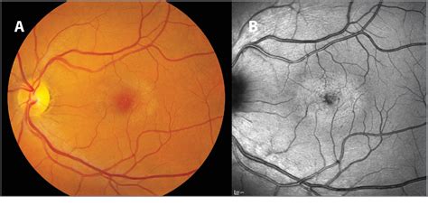 Figure 1 from The Diagnosis and Management of Macular Telangiectasia. | Semantic Scholar