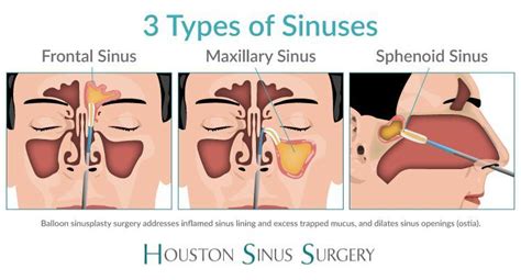 Sphenoid Sinus Disease Symptoms - Captions Ideas