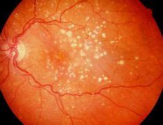 Macular Degeneration Signs and Symptoms