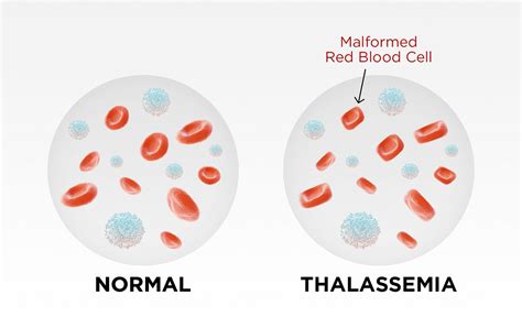 Thalassaemia. Pathophysiology | by Aayush Pokharel | Medium