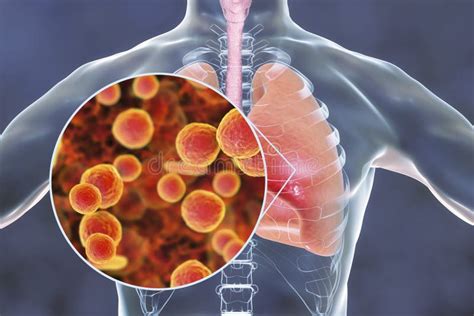 Mycoplasma Pneumoniae Bacteria in Human Lungs Stock Illustration - Illustration of lungs ...