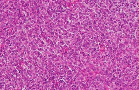 Spindle cell tumor with homogeneous appearance and plump nuclei (H & E... | Download Scientific ...