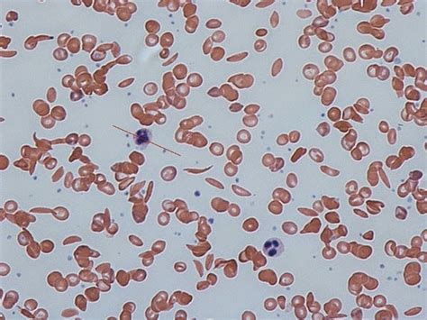 FICHERO DE HEMATOLOGÍA: ENFERMEDADES RELACIONADAS CON LOS GLÓBULOS ROJOS. Anemias. Anemia de ...