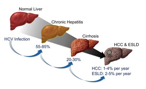 Natural History of Hepatitis C - Viral Hepatitis and Liver Disease