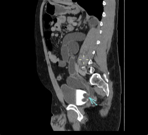 Ureterocele in adult man | Eurorad