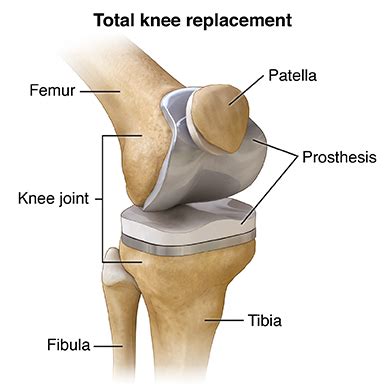 Total Knee Replacement Treatment, Symptoms & Conditions | Hawaii Pacific Health