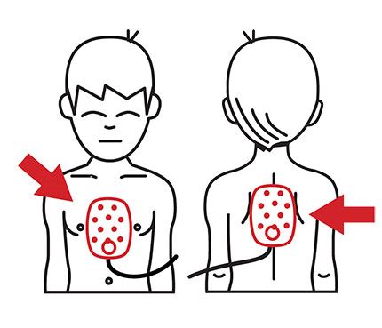 Philips HeartStart OnSite Child Pad Placement Guide - 989803139281 | American AED