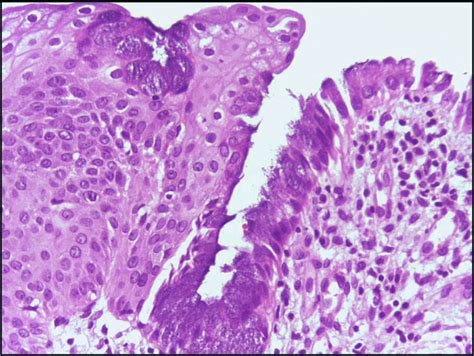 Squamous Metaplasia of Uterine Cervix