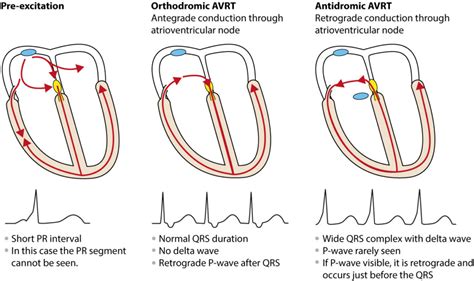 Pre-excitation, Atrioventricular Reentrant (Reentry) Tachycardia (AVRT), Wolff-Parkinson-White ...