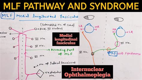 Medial Longitudinal Fasciculus(MLF) - Pathway and MLF Syndrome ...