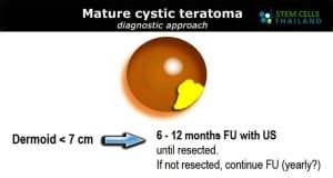 Teratoma Symptoms and Causes | Teratomas and Cancer