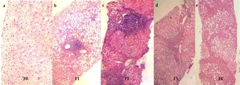 Radiologic Assessment of Liver Fibrosis – Present and Future | IntechOpen