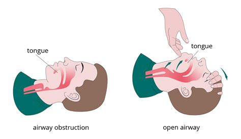 Airway management | Approach to the unresponsive patient | First Aid | Faculty of Medicine ...